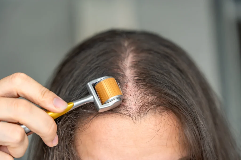 Kadınlarda Saç Dökülmesi Neden Olur Hangi Saç Ekimi Yöntemi Kullanılmalıdır