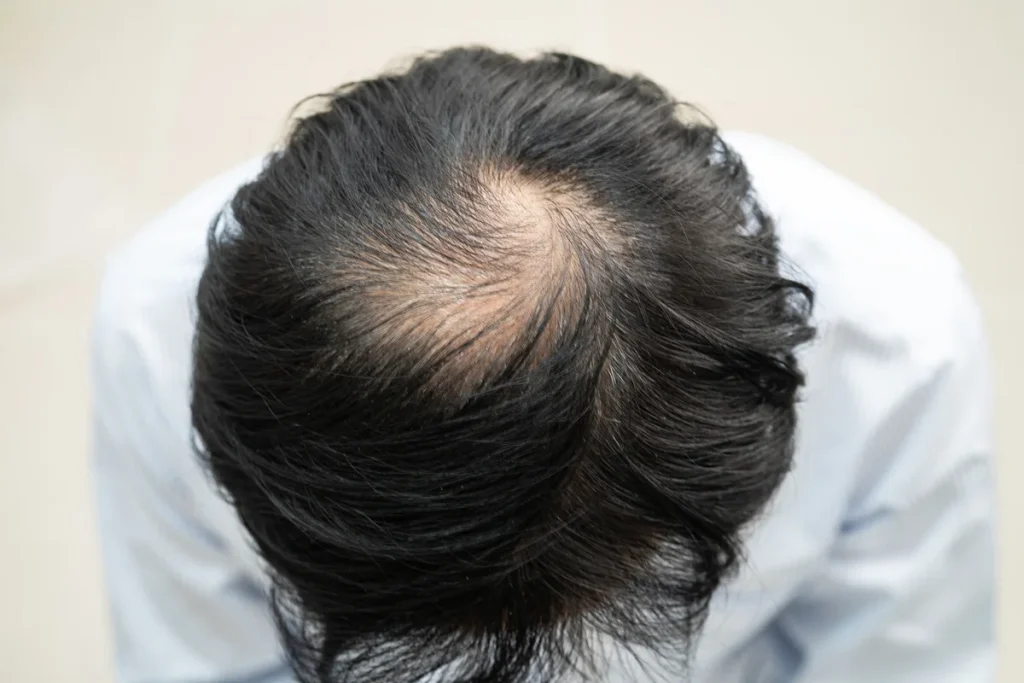 Saç Dökülmesi Nedenleri ve Çözümleri