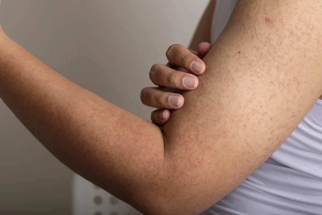 Tavuk Derisi Görünümü Neden Olur Keratosis Pilaris