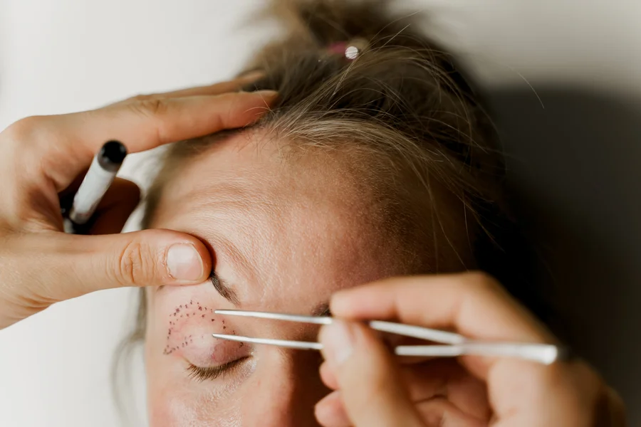 Universay Didim Hastanesi - Göz Kapağı Estetiği (Blefaroplasti)