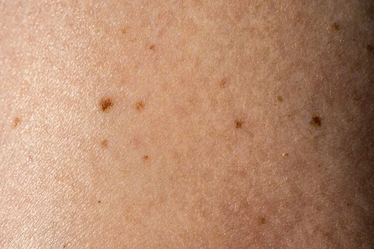 Cilt Lekeleri Hakkında Bilmeniz Gerekenler