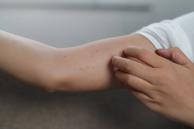 Ciltte Kaşıntı Nedir Kaşıntı - Sebepleri ve Çözüm Yolları