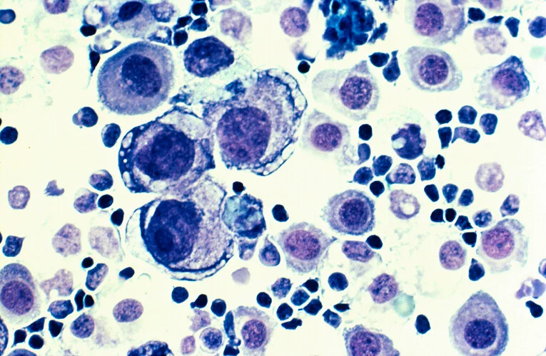 Sjögren Sendromu Belirtileri Ağız ve Göz Kuruluğuna Dikkat