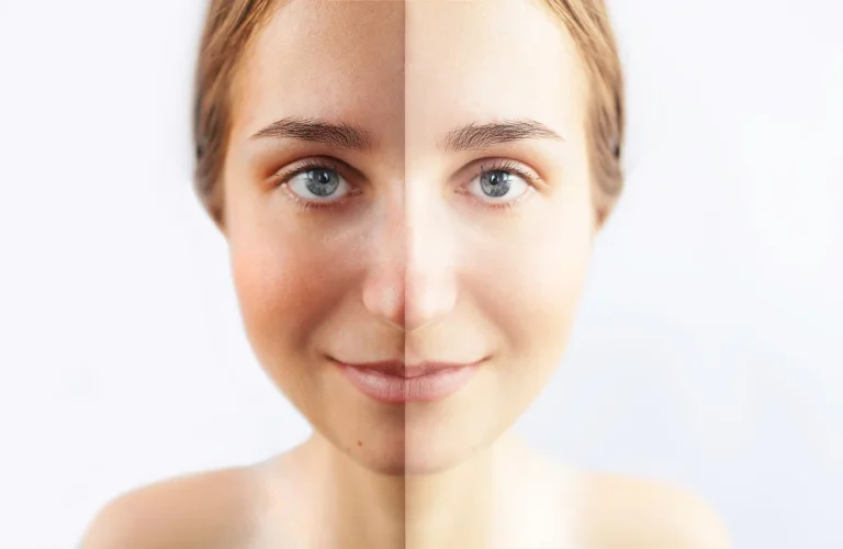 Cilt Beyazlatma Ameliyatı Nasıl Yapılır Öncesi ve Sonrası Süreç