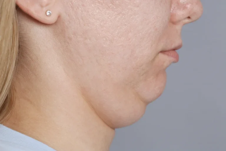 Gıdı Aldırma Nasıl Yapılır