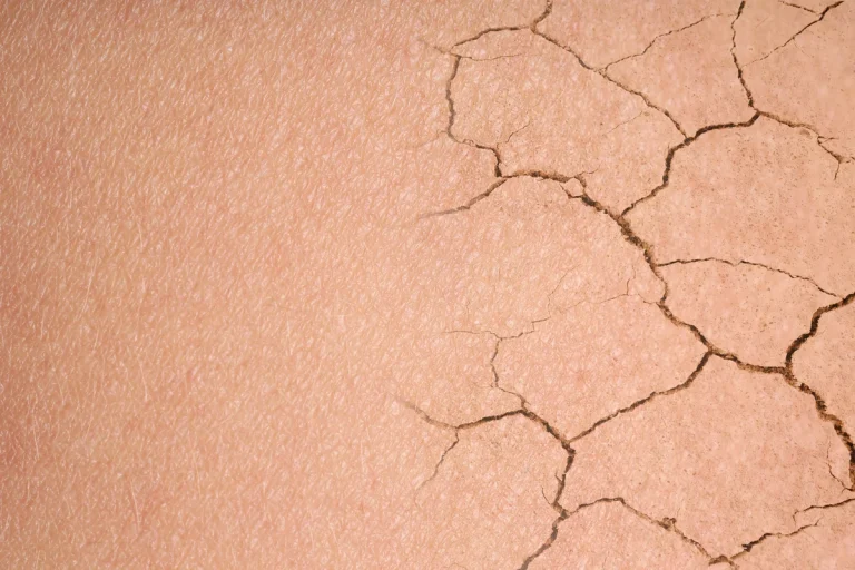 Kışın Cilt Kuruluğuna Karşı 7 Altın Kural