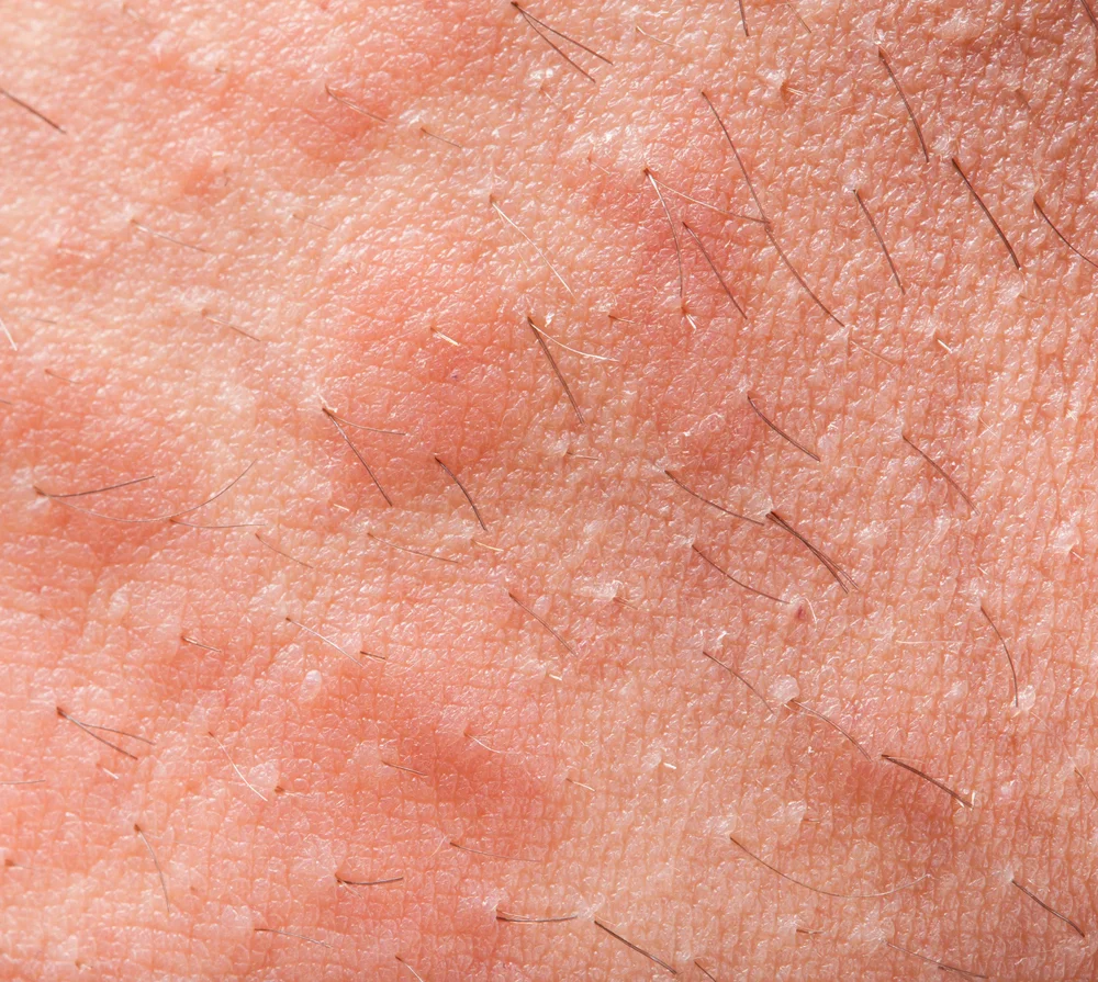 Sebum Nedir ve Cilt Sağlığınızı Nasıl Etkiler