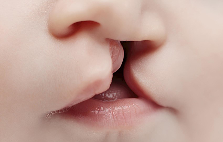 Tavşan Dudak Neden Oluşur ve Nasıl Tedavi Edilir