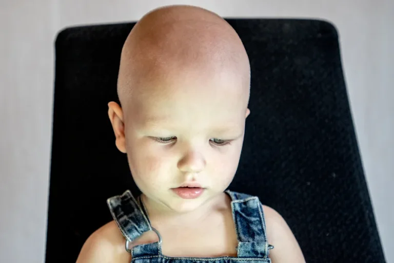 Kraniosinostoz Belirtileri Nelerdir?